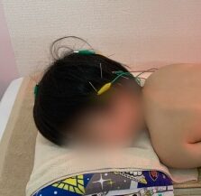 低酸素脳症（HIE）のお子さんが頭の鍼を受けている写真